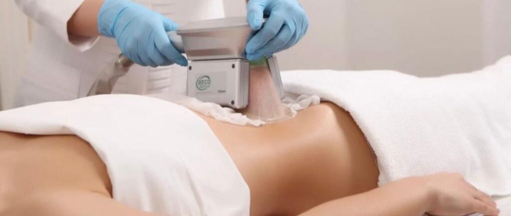 What Is Cryolipolysis